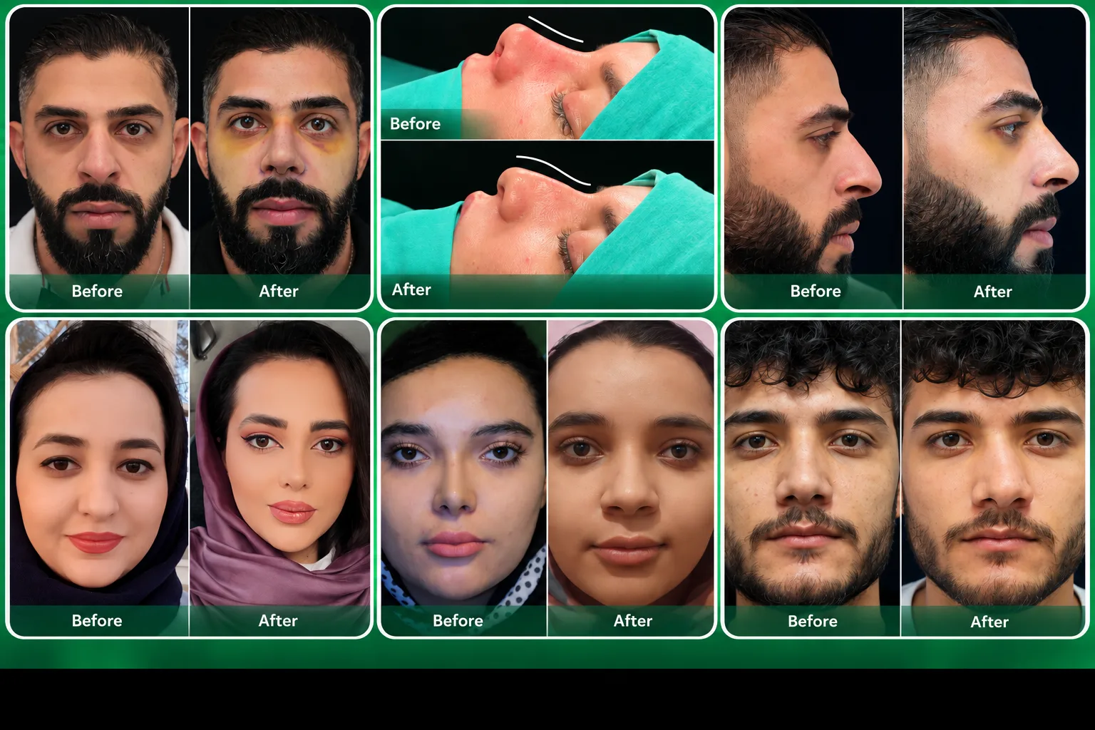صور توضيحية لعمليات تجميل الأنف